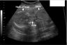 side view of Becky and Li's baby at 5 months' gestation
